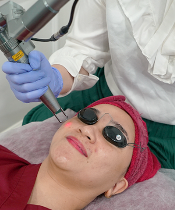 Laser Q-Switched Nd YAG