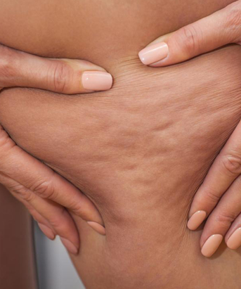 Anti Cellulite Therapy