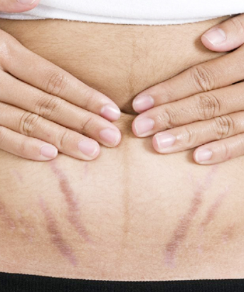 Stretch Mark Therapy