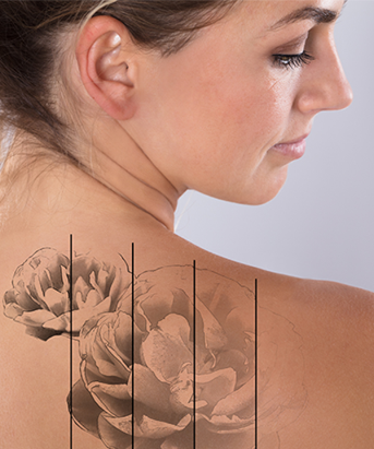 Tattoo Removal