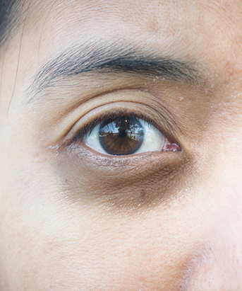 Dark Circle Eye