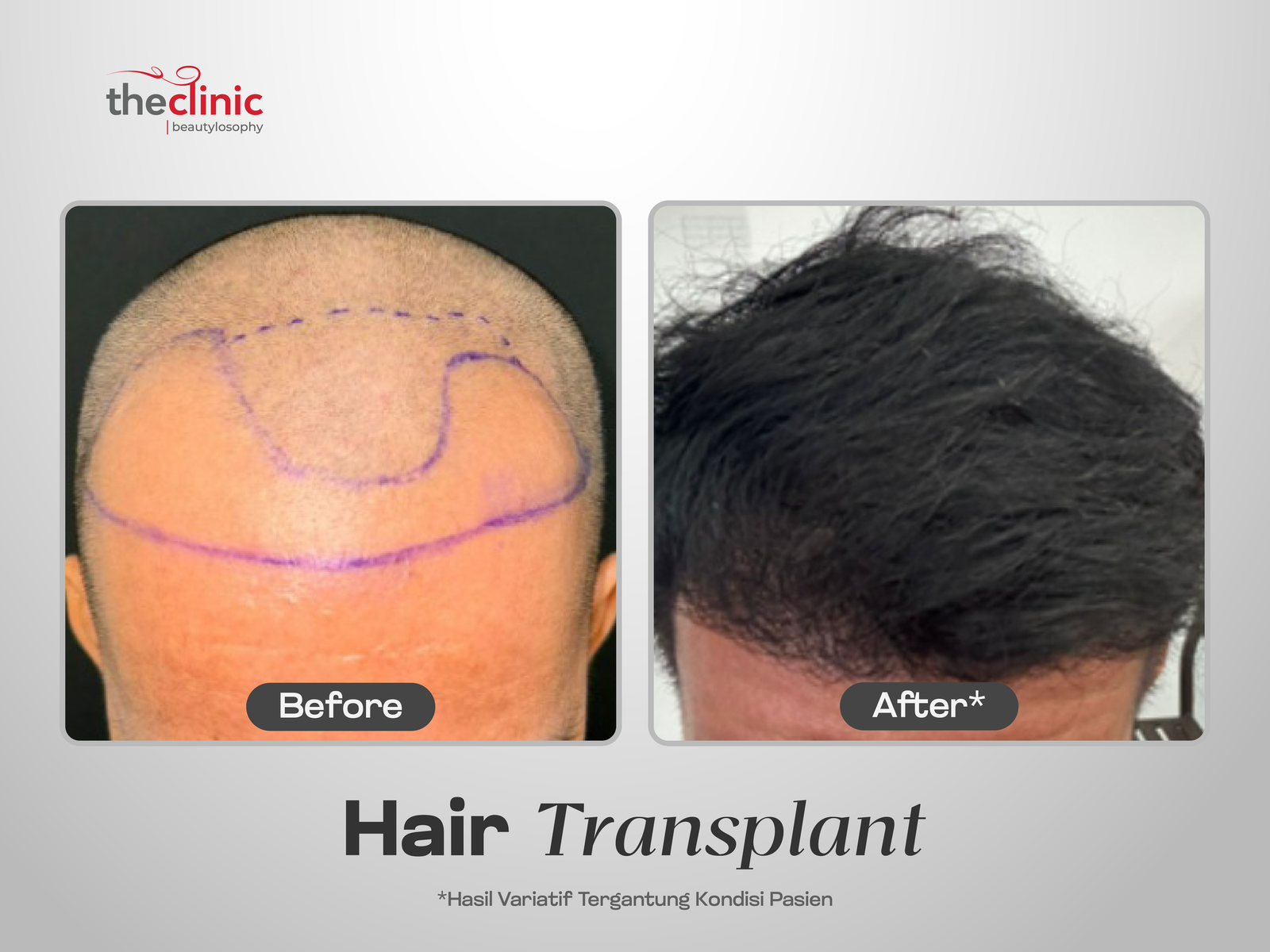 Hair Transplant
